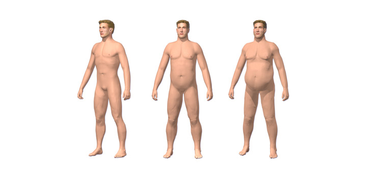 Body Surface Area Increases TKA Revision Risk
