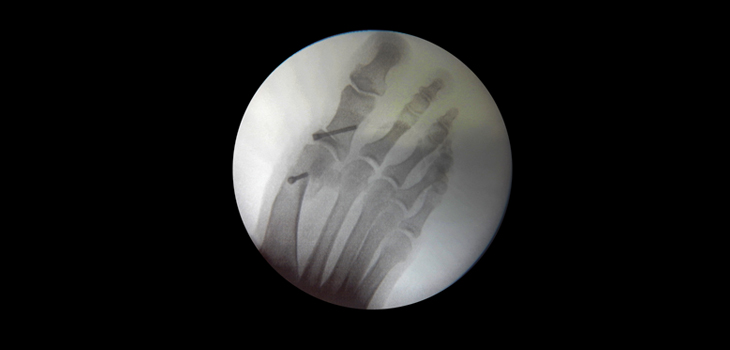 3D Bunion Correction Focus of New Clinical Study