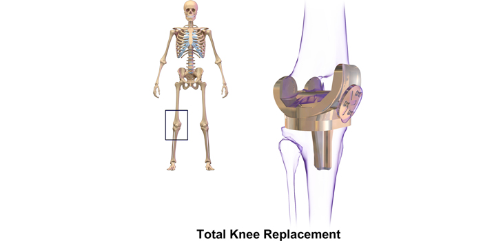 New Study: Medial Pivot Inserts Equivalent to Conventional