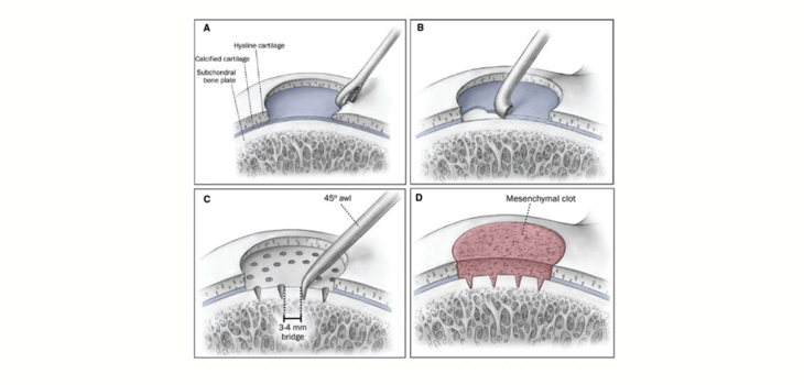 Cartilage Procedures: Indications, Trends, and Complication Rates