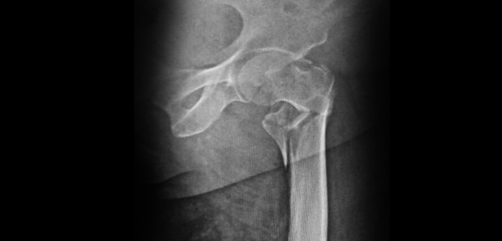 14,415 Patient Fracture Study: Screws or Nails?