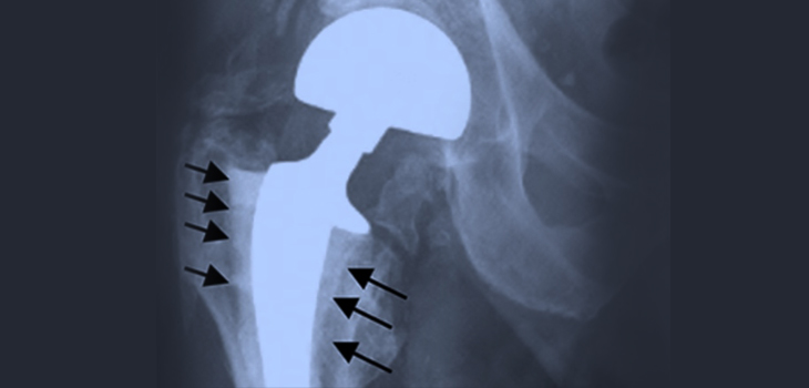 Elegant New Work From Rutgers Explains Implant Loosening