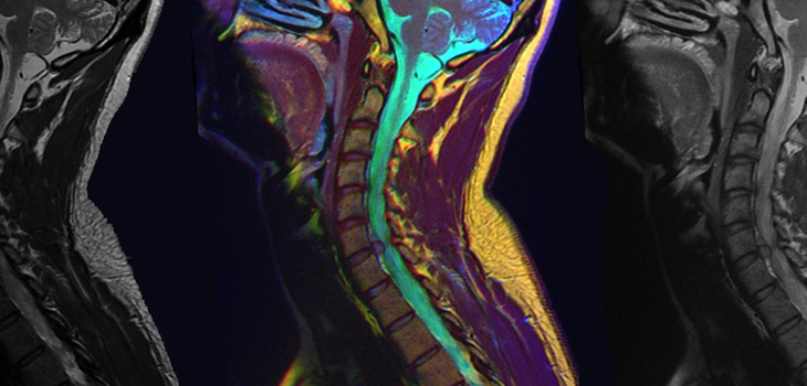 Cervical Disc Arthroplasty Not “Experimental.” Well, Yeah.