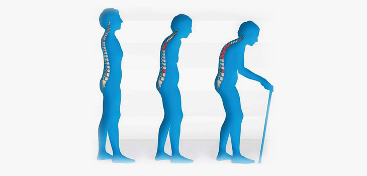 FDA Bone Panel Supports Amgen Osteoporosis Drug