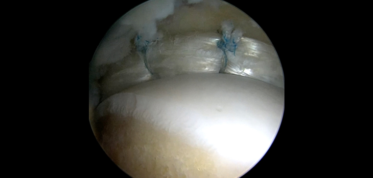 Labral Repair or Labral Reconstruction? New Study