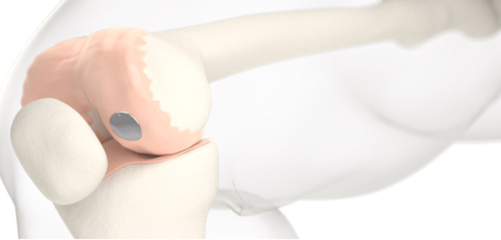Episealer Knee Implant IDE Approved by FDA