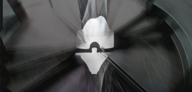 TKA Short-Stay Patients, Higher Readmission Rates. New Study