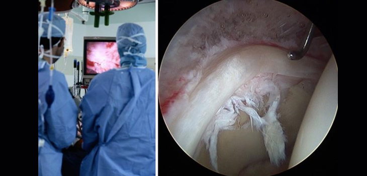 Does Prior Hip Arthroscopy Affect THA Outcomes?