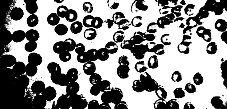 CDC: Patients Contaminated by Allograft Umbilical Cord Products