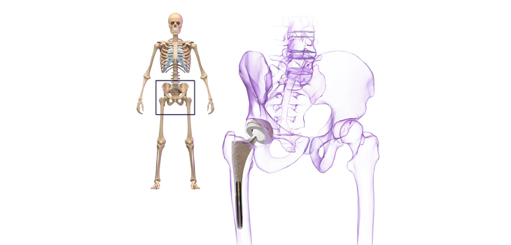 How Does THA Infection Affect Mechanical Failure Rates?