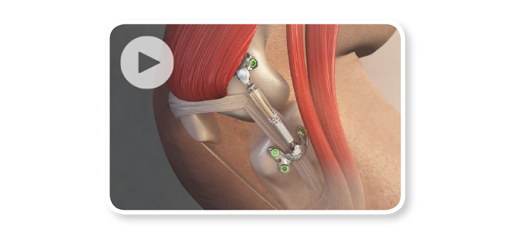 Inaugural Implant of Entirely New Knee Implant Design
