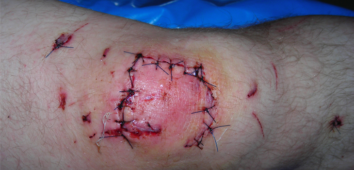 New Study Tackles Allograft Infection Risk