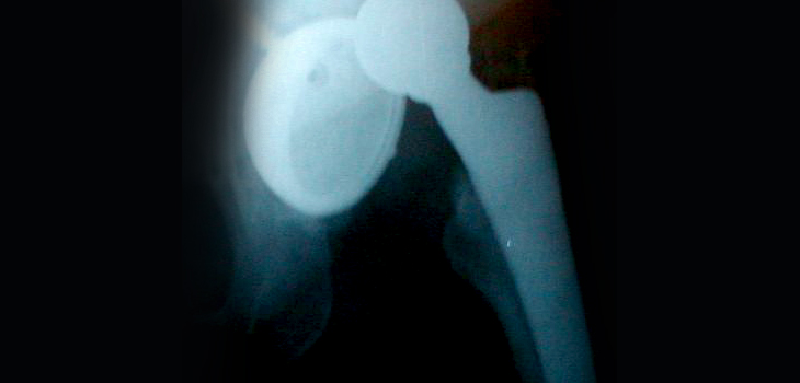 Dislocation Risk Among Spine Patients High