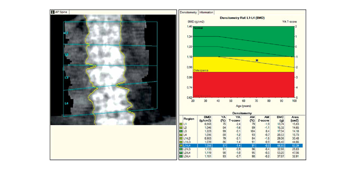 Over 90% of Fracture Patients Do NOT Get a Density Scan!