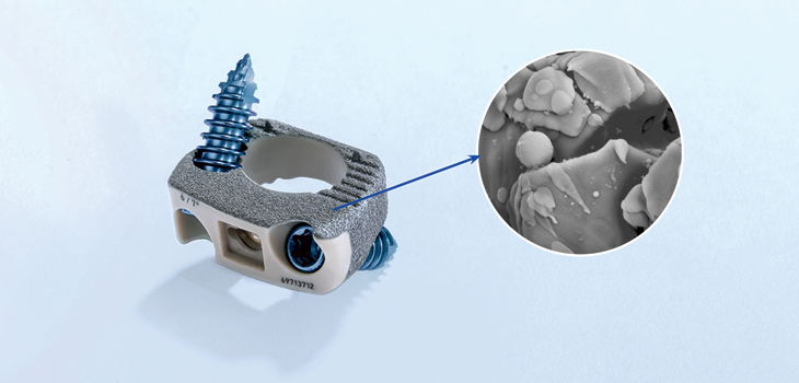 Histological Study Compares Aesculap’s PlasmaporeXP to Uncoated PEEK