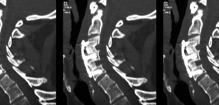 Unexpectedly, THIS Image Best Indicator of Pseudoarthrosis