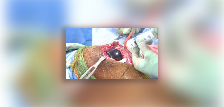 TKA: Local Injection Anesthesia vs Femoral Nerve Block