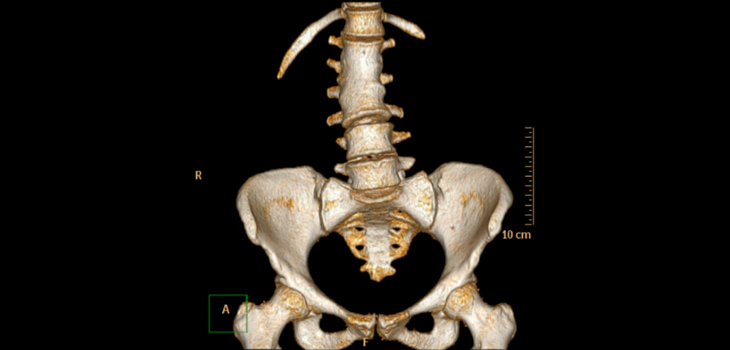 Do Spine Fusion Patients With Hip Arthroplasty Risk Dislocation?
