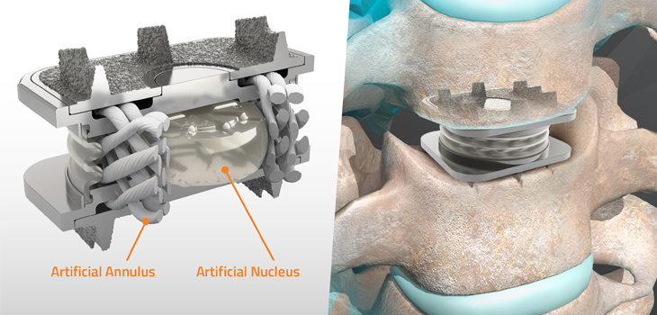 Here Comes Orthofix’s M6 Cervical Disc