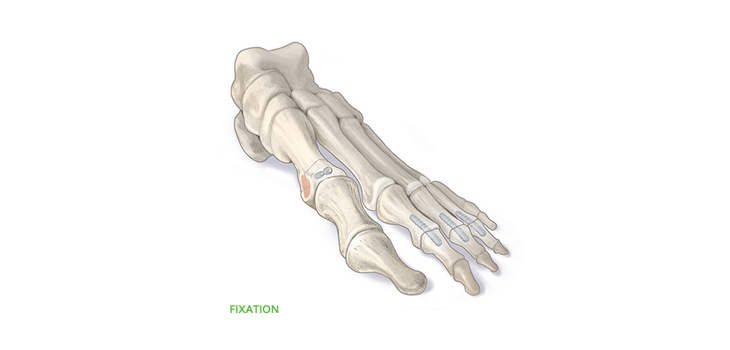Bone Fixation Innovator OSSIO Raises $22 Million