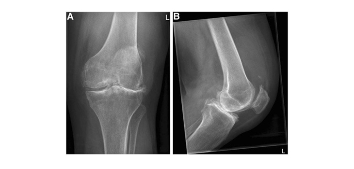 Predictors of Osteoarthritis After ACL Repair