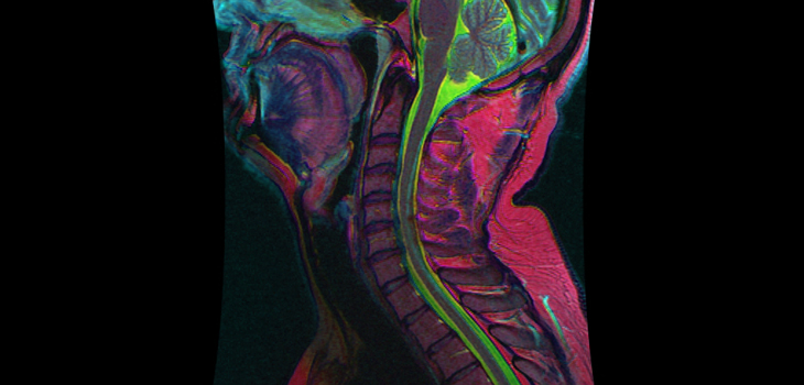 Time to Seriously Consider Focused MRIs for Injured Spines