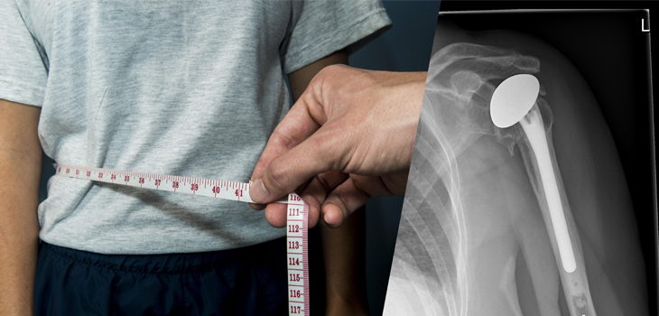 Being Underweight a Risk for Total Shoulder Arthroplasty?