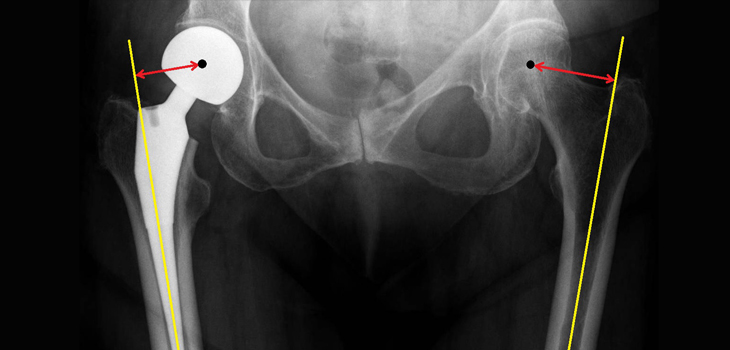 Conversion of Hemiarthroplasty to THA: Risky Business?