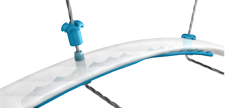 SIG Medical’s Rib Fracture Repair System Cleared by FDA