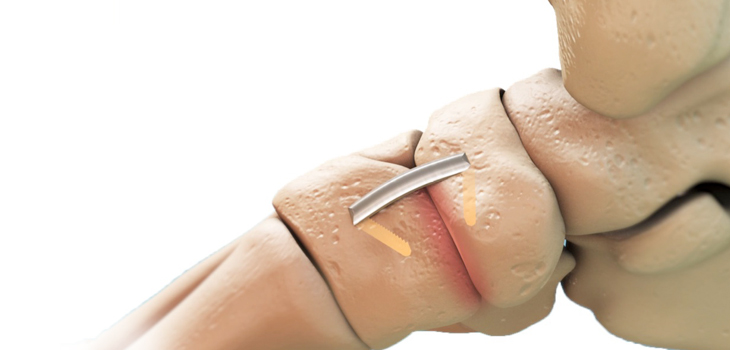 MedShape Announces Launch of DynaClip™ Bone Fixation System