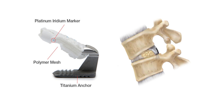 The Rough Road to FDA Approval for Barricaid Anular Closure Device
