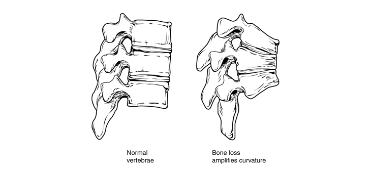 Incidence of Osteopenia/Osteoporosis in Spine Fusion Patients