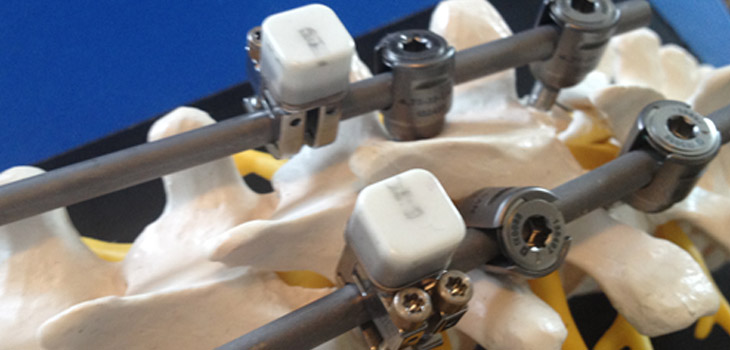 “First-Ever” De Novo Approval for LOADPRO Spinal Rod Strain Sensor
