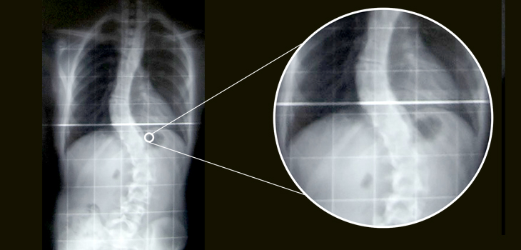 Scoliosis Classification System Teases Out Patient Differences