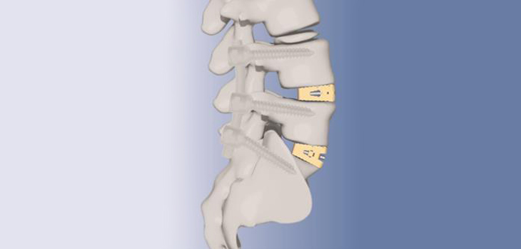 Osaka-Based KiSCO Picks Solvay’s PEEK Implants for Japan