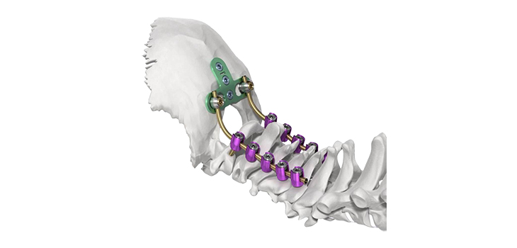 FDA Designates Posterior Cervical Screws Class II Devices