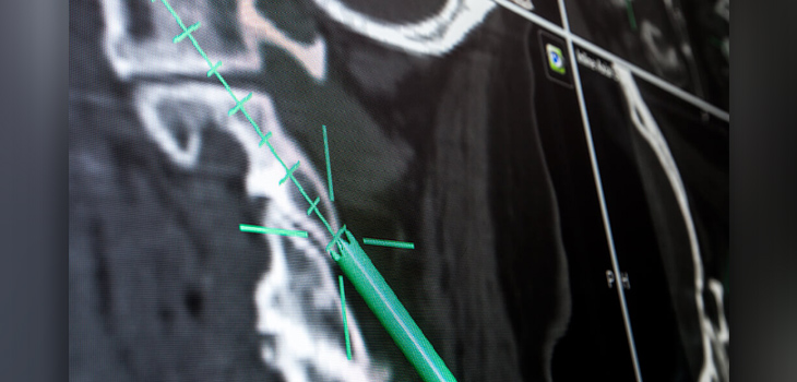 Brainlab Issues Class 1 Recall of Its Spinal Navigation Software