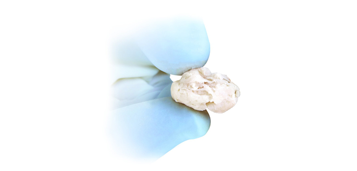 New Cartilage Treatment Makes Filling Defects Easier