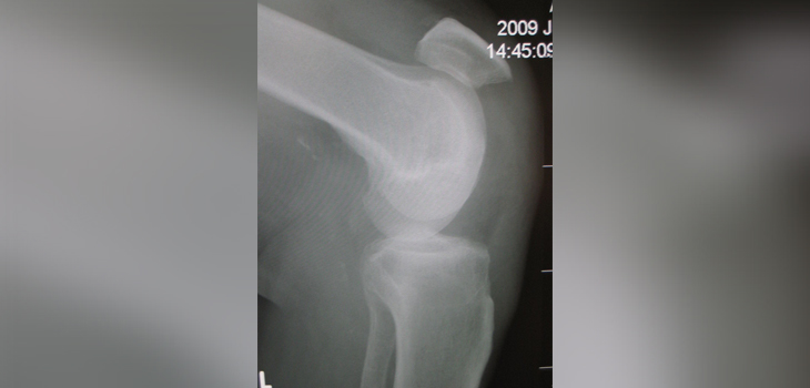 Post-TKA Patellar Tendon Rupture? New Study Has Answers
