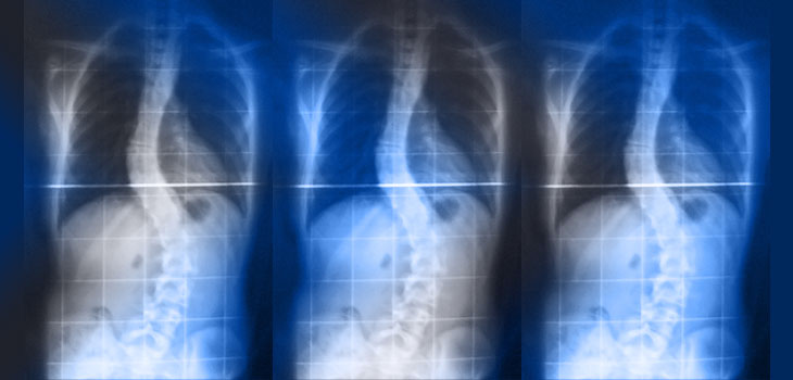10-Year Outcome Data on “Selective Fusion” in Scoliosis