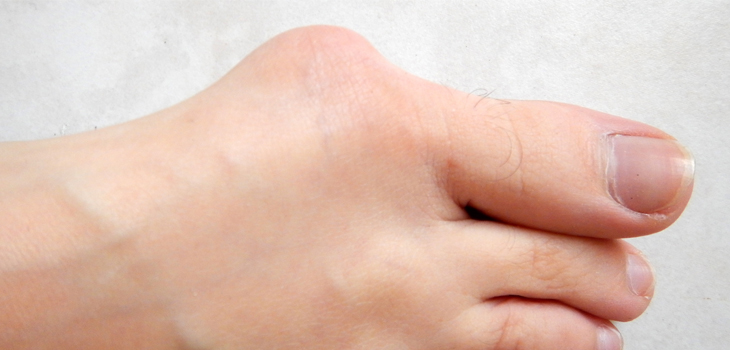 Bunion Correction With Lapiplasty Data Released