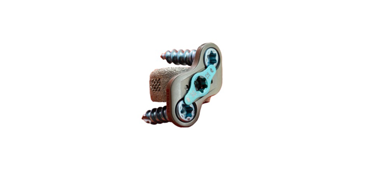 FDA Clears ChoiceSpine Cervical Fusion System