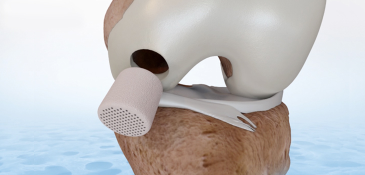 Getting Cartilage Repair Right – After 25 Years