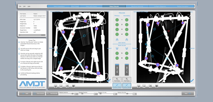 SixFix Hexapod Fixator Hardware and Software Cleared by FDA