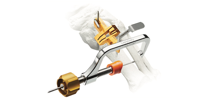 Treace Medical Bunion System Cleared for Pediatrics