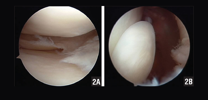 Only 50-68% of Partial Meniscectomy Patients Satisfied