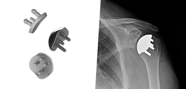 Catalyst OrthoScience Raises $12.7 Million