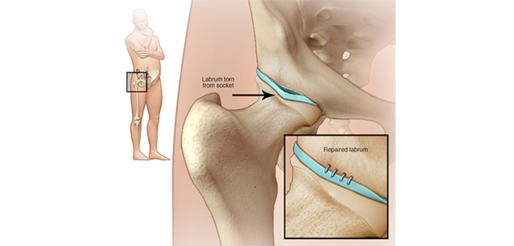 Acetabular Labral Repair: Patients 60+ Fare Well Too?