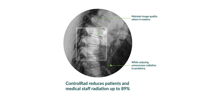 Radiation Reducing ControlRad Trace C-Arm Accessory Cleared by FDA