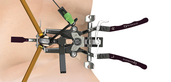 Novel XLIF Positioning System Cuts OR Time by 1 HOUR!